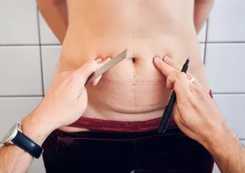 Does Insurance Cover Breast Lift: Unveiling the Truth